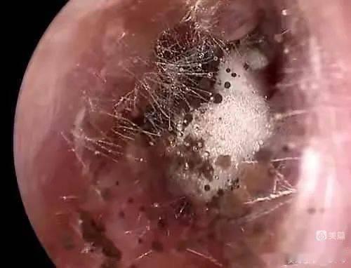 你知道吗？采耳须谨慎，小心真菌找上门